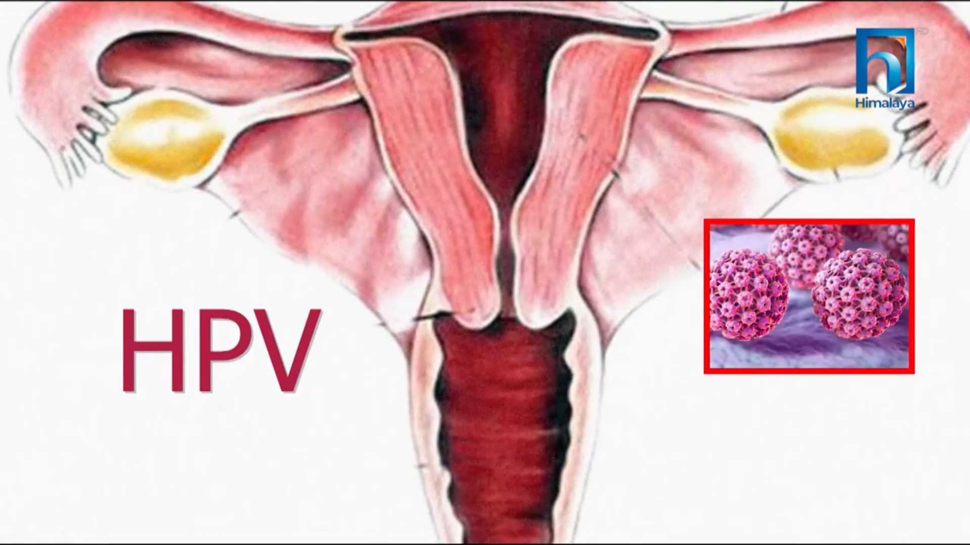 क्यान्सर छेक्ने  एचपीभी खोप के हो ? (भिडियो रिपोर्टसहित)
